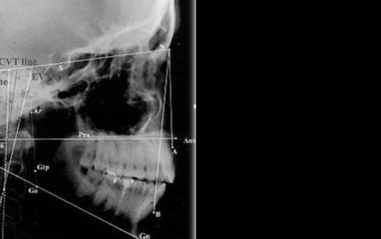 Avaliação da postura cervical em crianças com Classe I, II, e III