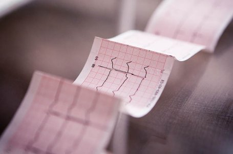 Como identificar uma coronariopatia no ECG? Download de algoritmo