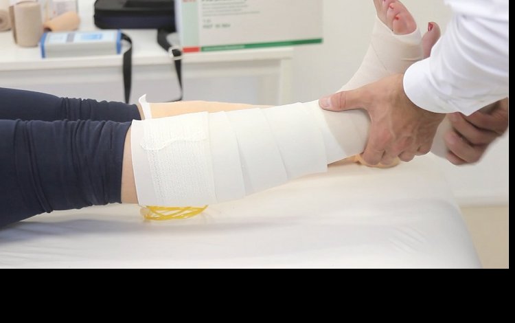 Úlcera de perna etiologia, fisiopatologia, achados clínicos e classificação