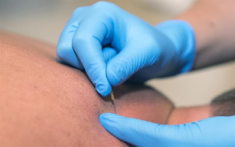 Webinar Punção Seca nas Cefaleias decorrentes de Trigger Points no Trapézio Superior com Alexandre Cavallieri Gomes