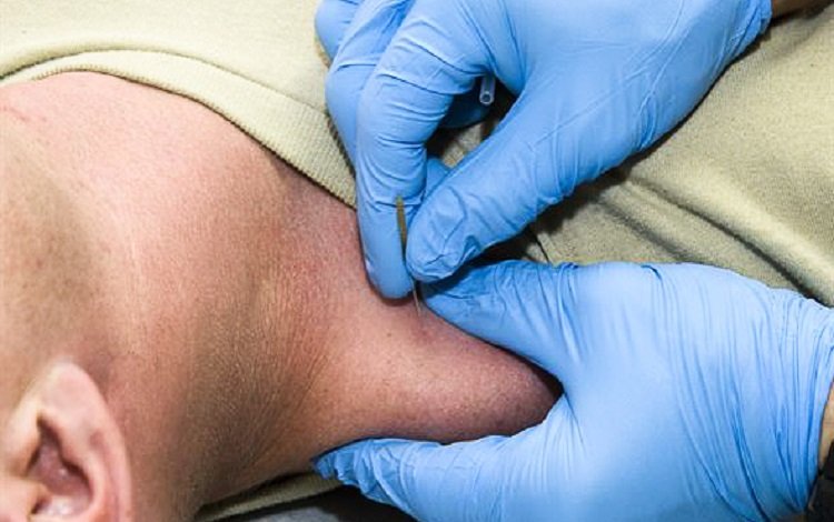 Trigger points eficácia da punção seca (dry needling) em idosos com dor inespecífica no ombro