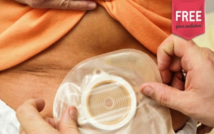 Estomaterapia: Quais os vários tipos de ostomias?