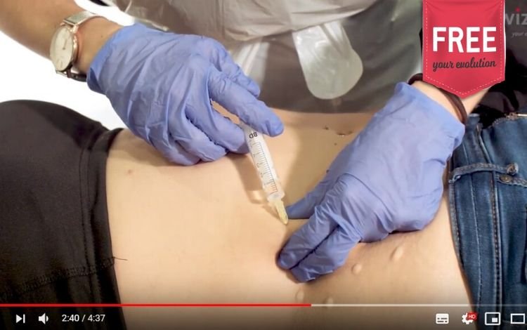 mesoterapia para redução de gordura localizada e estrias