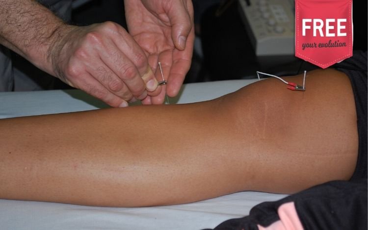 Efeito da intensidade da eletropuntura na dor crónica em pacientes com osteoartrite do joelho