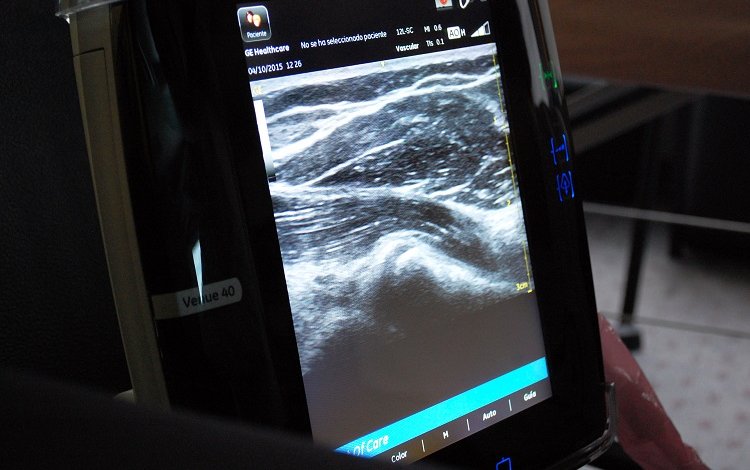 Ecografia músculo-esquelética nas lesões musculares dicas e achados clínicos