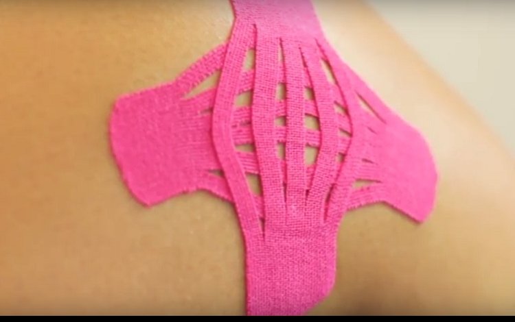 Kinesio Taping: técnica para uma fase aguda de lesão grau 1 ou 2 do ligamento lateral interno (colateral medial)