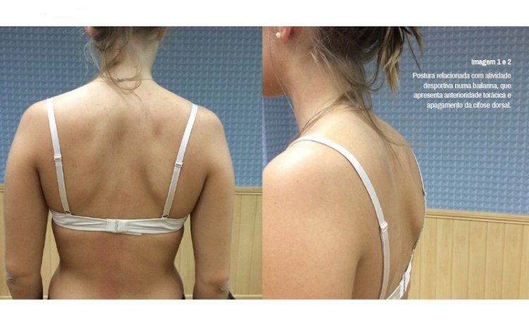 Anterioridades Torácicas e Dor Cervical | por João Tedim (Bwizer Magazine)