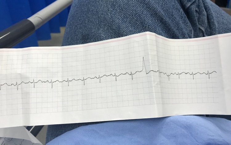 Como identificar uma coronariopatia no ECG? Download de algoritmo